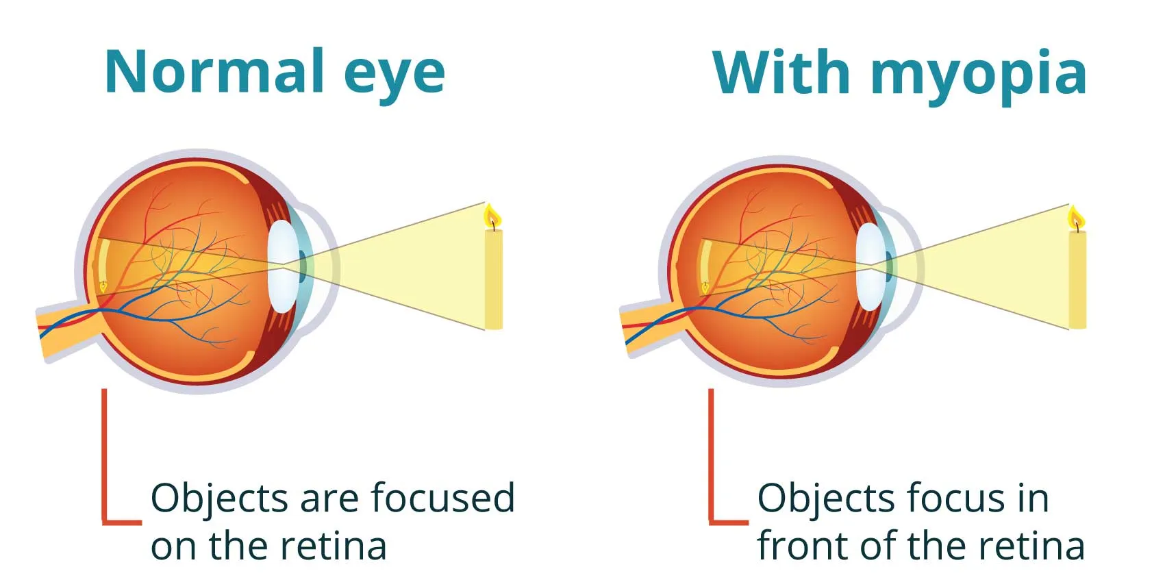 Diagram showing how myopia (short-sightedness) affects focus in the eye