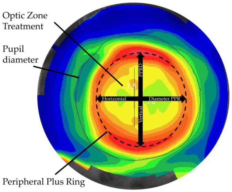 Optic Zone Treatment Image